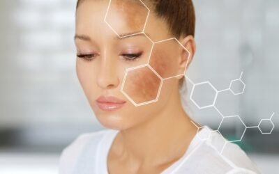 Dark spots and hyperpigmentation reduced with peels