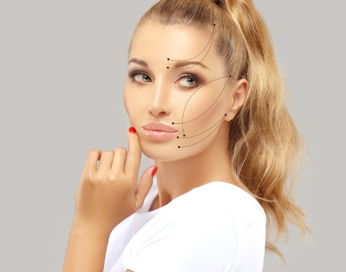 Loose skin around the eyes lifted with PDO threads