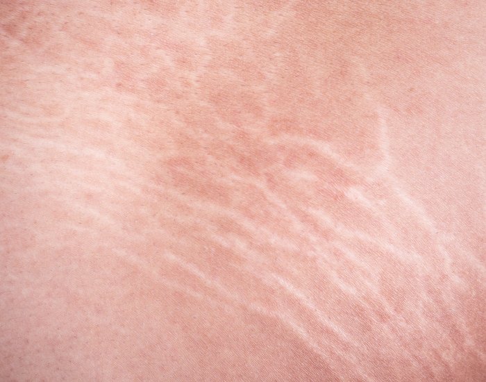 Stretch marks and enlarged pores reduced with microneedling